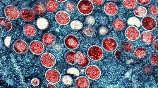  Beim Menschen wurden Mpox erstmals 1970 in der Demokratischen Republik Kongo identifiziert (Symbolbild).