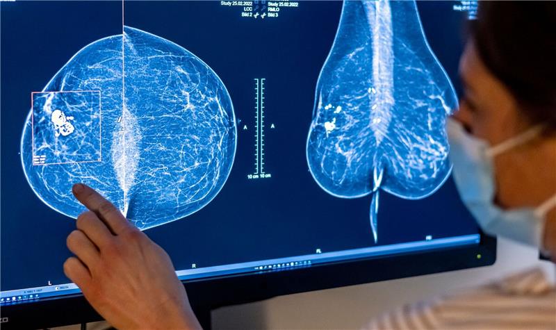 Brustkrebs-Früherkennung künftig bis 75 Jahre Brustkrebs ist die häufigste Krebserkrankung bei Frauen in Deutschland.