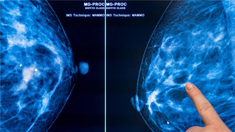 Mammografie-Screening senkt Brustkrebs-Sterblichkeit Brustkrebs stellt mit etwa 75.000 Neuerkrankungen jährlich die häufigste Krebserkrankung bei Frauen in Deutschland dar. (Archivbild)