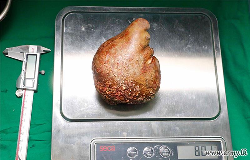 Guinness-Buch: Größter Nierenstein der Welt entfernt Das Foto zeigt den Nierenstein auf einer Waage.