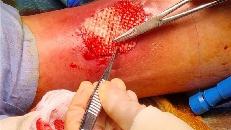 Das Omega-3 in der Fischhaut fördert die Heilung großer Wunden. 