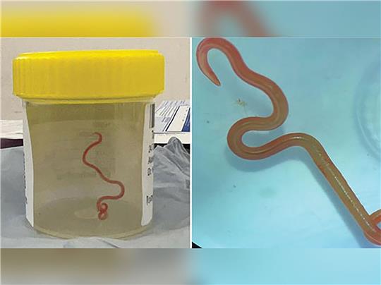 Das undatiertes Bild zeigt den lebenden Spulwurm «Ophidascaris robertsi», der im Gehirn einer 64-jährigen Australierin gefunden wurde.