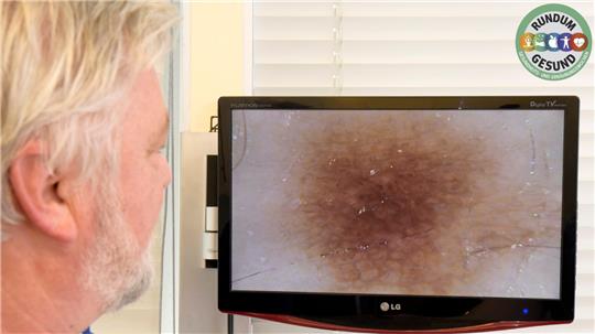 Der Hautarzt Dr. Karl-Armin-Doehnel untersucht einen Leberfleck. Das Pigment-Netz ist unauffällig. Foto: Bernward Comes