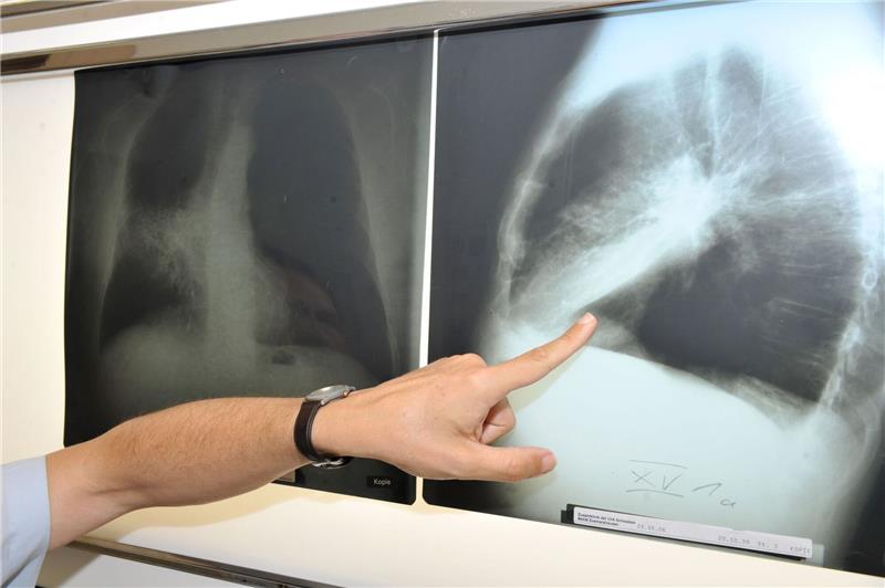 Zahl der Krebs-Toten in der EU geht zurück Der Leiter der Pneumologie (Lungenheilkunde) im Klinikum der Universität München zeigt auf ein Röntgenbild einer von Krebs befallenen Lunge.