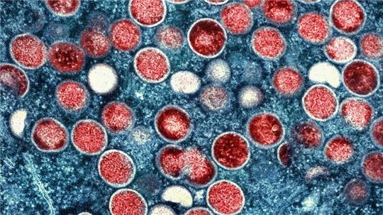 Die WHO ist besorgt über die mögliche Ausbreitung einer neuen Mpox-Sublinie 