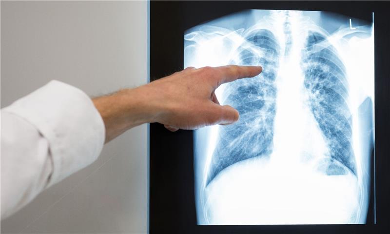 Die Weltgemeinschaft ist nicht auf Kurs, ihre selbstgesteckten Ziele zur Eindämmung der Tuberkulose zu erreichen.