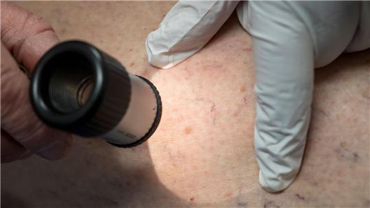 Die Zahl der Krankenhausbehandlungen von Hautkrebs stieg enorm an. (Symbolbild)