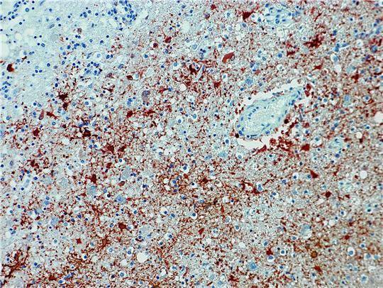 Die undatierte Aufnahme zeigt einen Anitkörpernachweis zum Borna-Virus im Gewebe.