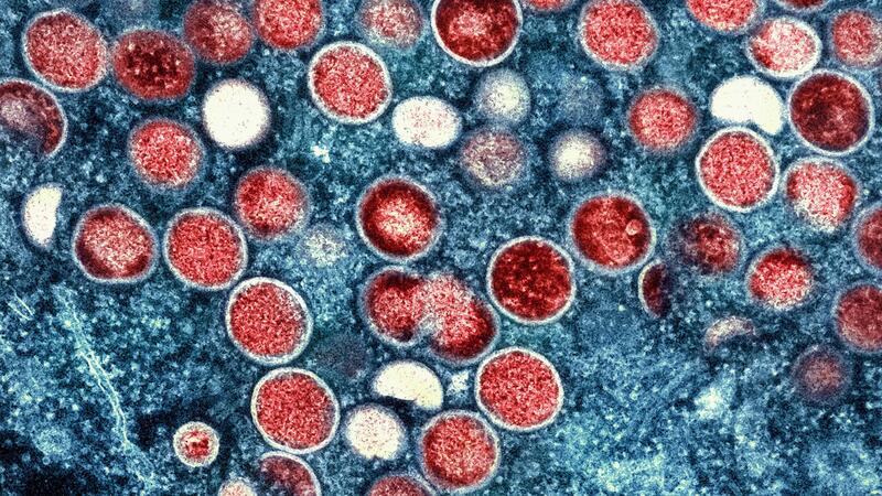Behörde: Mehr Mpox-Fälle in Europa zu erwarten Diese Mikroskopaufnahme zeigt Mpox-Partikel in einer Zelle.