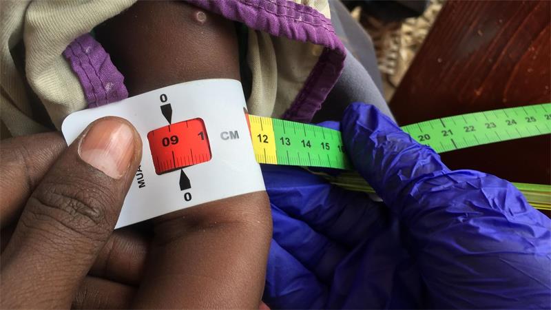 Hungerkrisen: Afrika fällt weiter zurück Ein Arzt misst den Armumfang eines unterernährten Babys. Mehr als die Hälfte der Bevölkerung in Somalia ist chronisch unterernährt. (Archivbild)