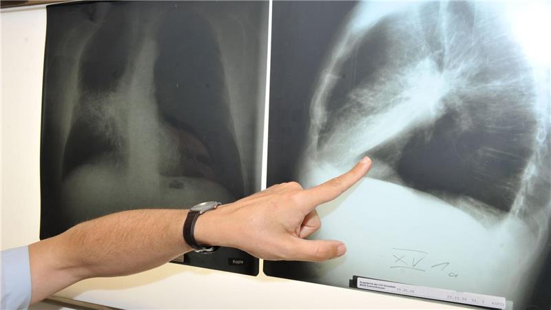 Ein Arzt zeigt auf ein Röntgenbild einer von Krebs befallenen Lunge.