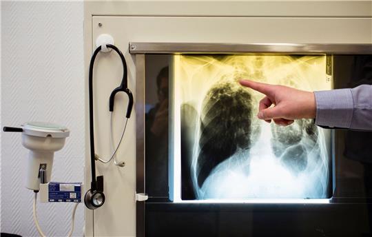 Ein Arzt zeigt einen Tuberkulose-Fall anhand eines Röntgenbildes in seinem Büro im Tuberkulosezentrum.