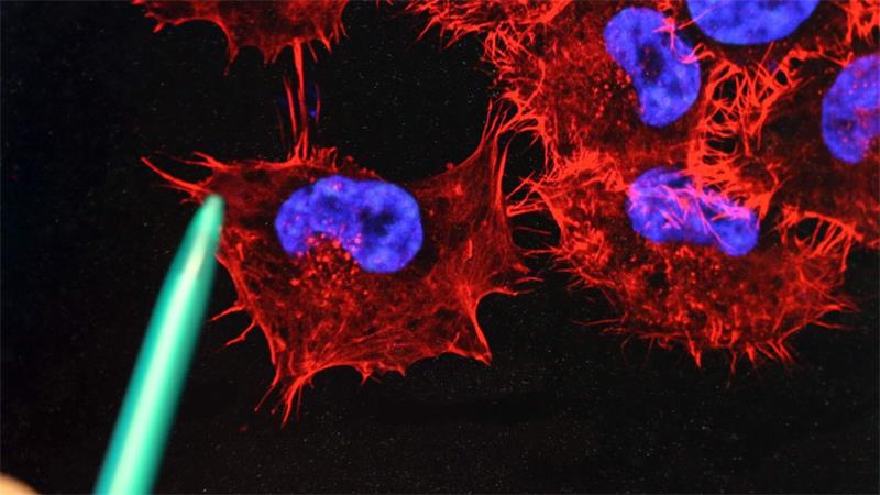 Studie: Hilft die mRNA-Impfung gegen Schwarzen Hautkrebs? Ein Monitor mit einem Bild von Melanom-Zellen. (Archivbild)