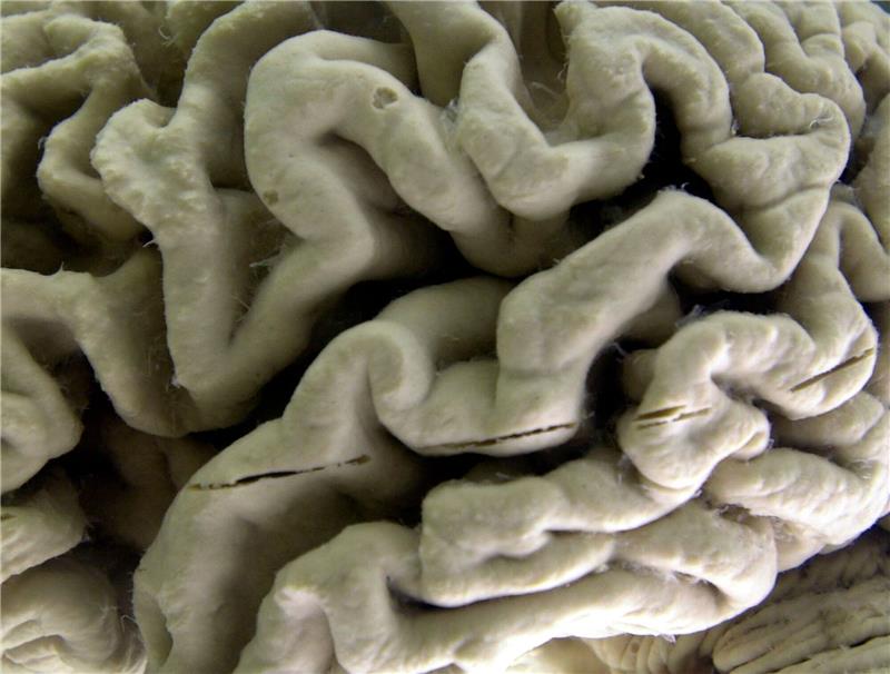 US-Arzneibehörde vergibt Zulassung für Alzheimer-Medikament Eine Nahaufnahme eines menschlichen Gehirns, das von der Alzheimer-Krankheit betroffen ist, ausgestellt im Museum für Neuroanatomie an der University at Buffalo.
