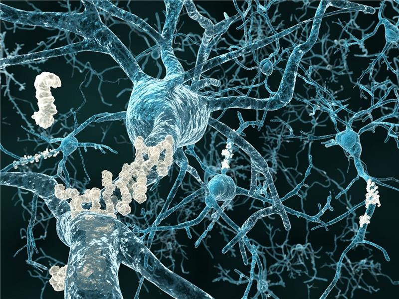Studie: Alzheimer-Medikament verlangsamt geistigen Abbau Eiweißablagerungen zwischen den Nervenzellen (Plaques) sind zum Teil ursächlich für Alzheimer-Symptome.