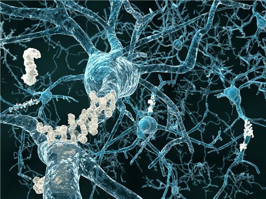 Eiweißablagerungen zwischen den Nervenzellen (Plaques) sind zum Teil ursächlich für Alzheimer-Symptome.