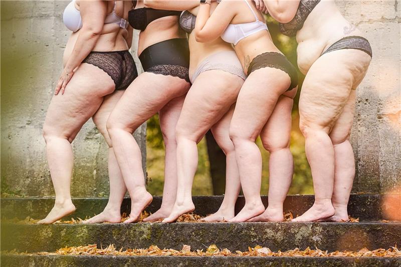 Verbreitet und oft unerkannt: Schweres Leid durch Lipödem Frauen mit Lipödem-Erkrankung. Betroffene kämpfen für eine Ent-Stigmatisierung der Krankheit und fordern mehr kompetente Ärzte.