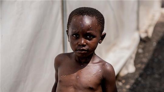Für Kinder kann Mpox besonders gefährlich sein (Archivbild) 