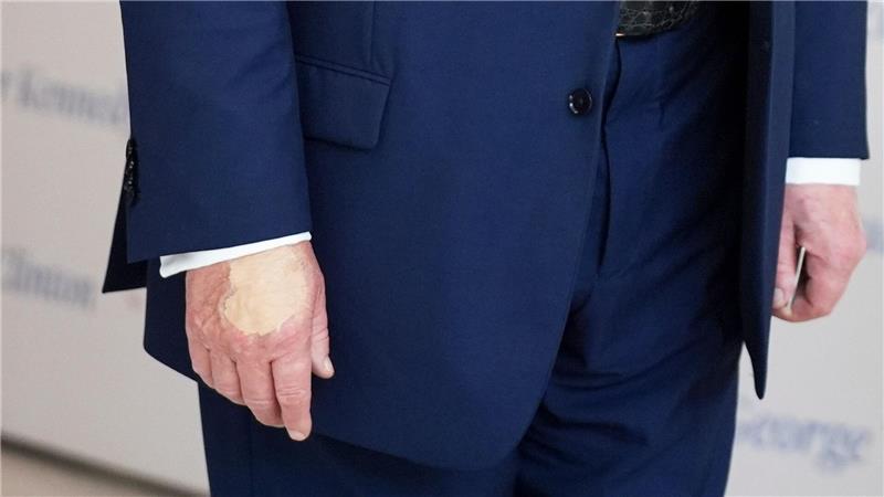 „Ich bin kein Diktator“ - wohin driften die USA unter Trump? Für Trump ein unliebsames Thema: die überschminkte Hand (Archivbild).