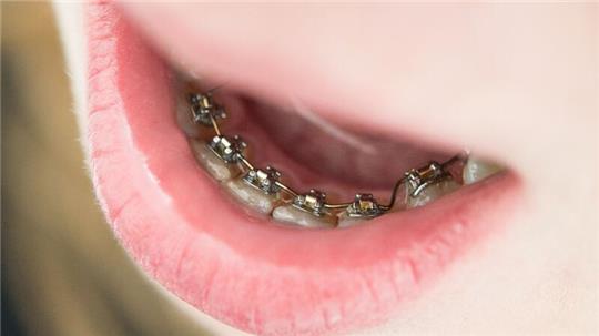 Gegen schiefe Zähne hilft eine Zahnspange.