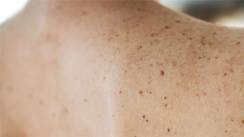 Frühlingswetter: UV-Schutz essenziell für Krebsprävention Hautkrebs ist einer der häufigsten Krebserkrankungen in Deutschland.
