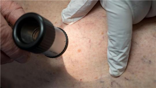 Hautkrebsfälle steigen nach Krankenkassen-Zahlen in Niedersachsen deutlich an. (Symbolbild)