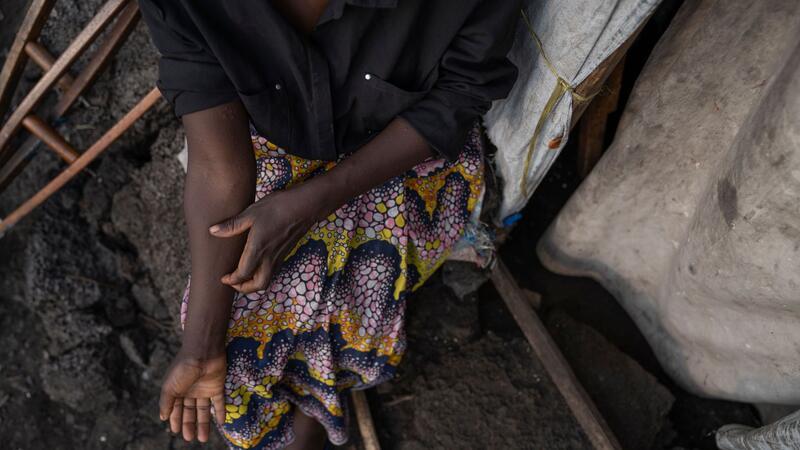 Behörde: Mehr Mpox-Fälle in Europa zu erwarten In Afrika gibt es schon 14.000 Mpox-Verdachtsfälle.