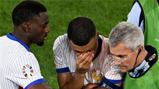 Mbappé (M) musste mit stark blutender Nase ausgewechselt werden.
