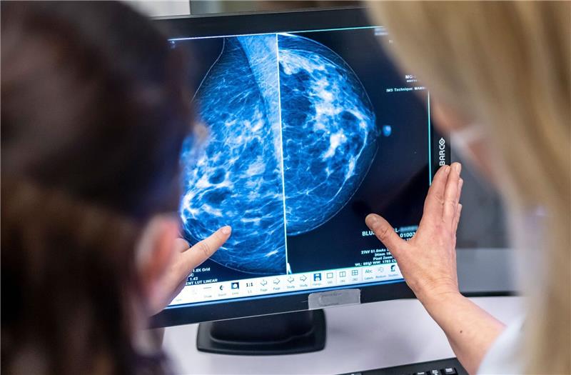 Vorbeugendes Mittel gegen Brustkrebs für britische Frauen Medizinisches Personal untersucht mit einer Mammographie die Brust einer Frau auf Brustkrebs.