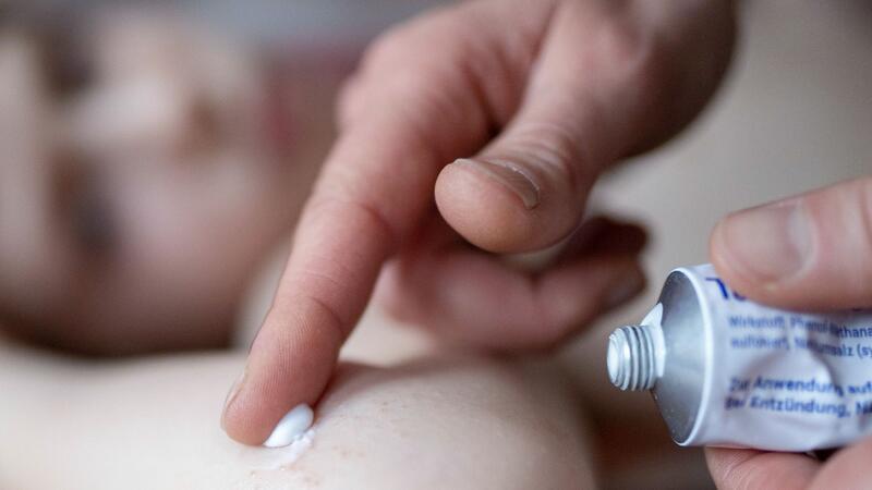 5 häufige Hautprobleme und was Sie dagegen tun können Menschen mit Neurodermitis sollten sich häufig eincremen. Das spendet der Haut Feuchtigkeit und reduziert den Juckreiz.