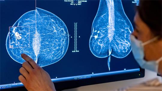 Mit einer Mammografie untersuchen Ärzte die Brust einer Frau auf Brustkrebs - nun gelten geänderte Regeln. (Symbolfoto)