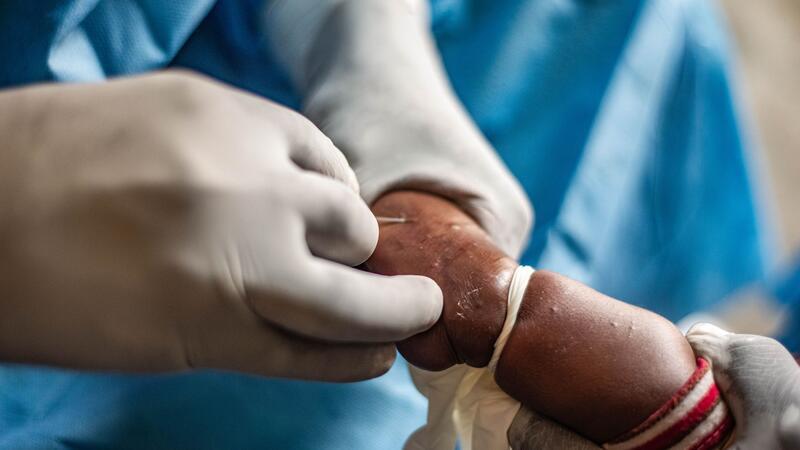 Höchste Alarmstufe wegen Mpox - was bedeutet das? Mpox breitet sich in Afrika derzeit immer mehr aus. Hier wird ein Kind behandelt. (Archivbild)