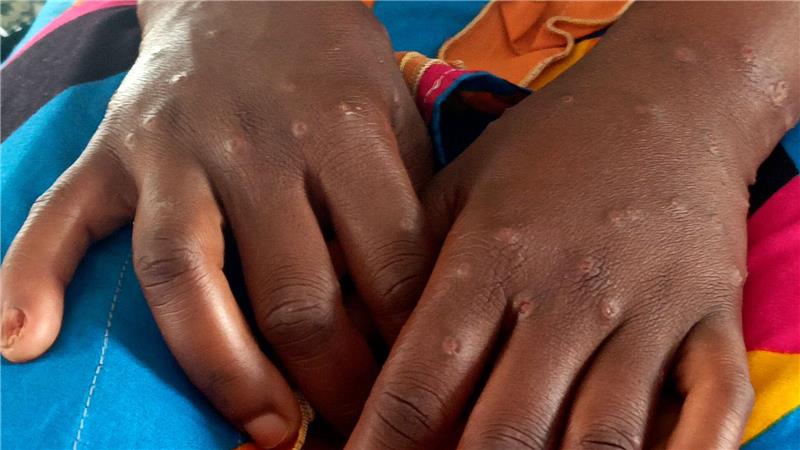 Internationale Notlage wegen Mpox aufgehoben Mpox ist vor allem für kleine Kinder und immungeschwächte Menschen gefährlich (Archivbild)