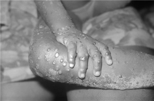 Nahaufnahme einer Infektion mit Affenpocken bei einem vierjährigen Kind in Liberia. Foto: CDC Public Health Image Library