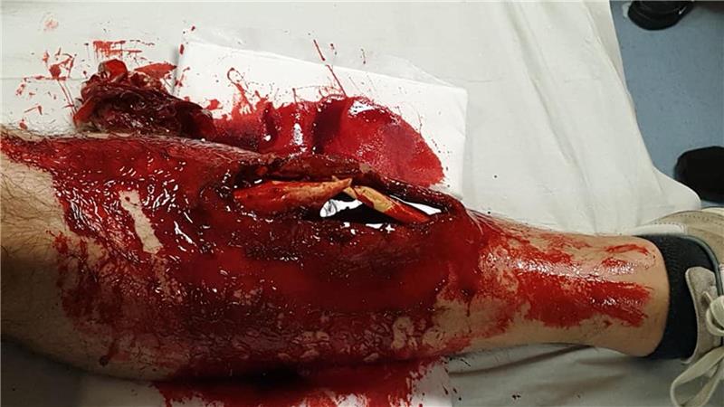 Blut und Knochensplitter für perfekt geschminkte Unfallopfer Offene Unterschenkelfraktur – perfekt nachgebaut von Stefan Kruse mit Wachs, Kunstblut und Schweineknochen.