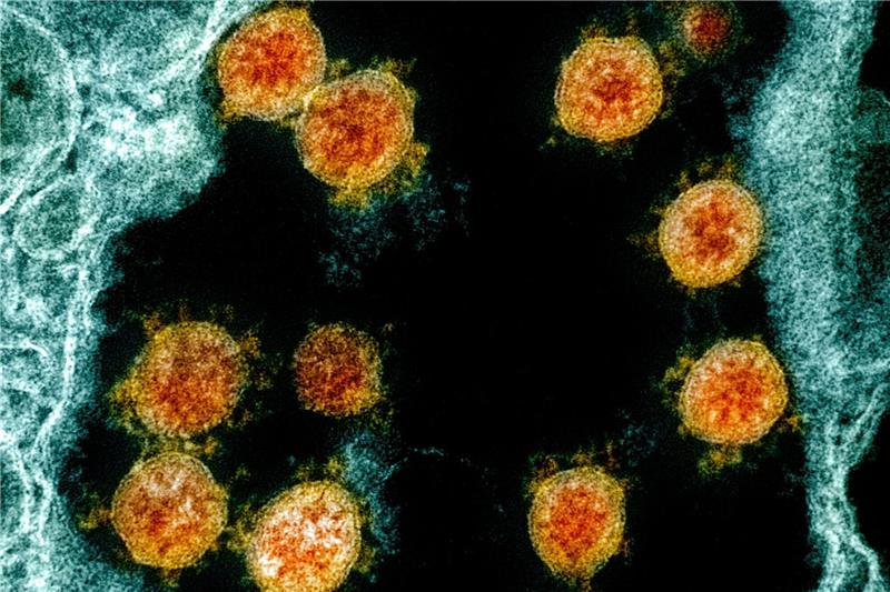 613 Tage lang Corona: Seltener Infektionsfall vorgestellt Partikel des Coronavirus SARS-CoV-2 wurden für eine elektronenmikroskopische Aufnahme farblich bearbeitet.