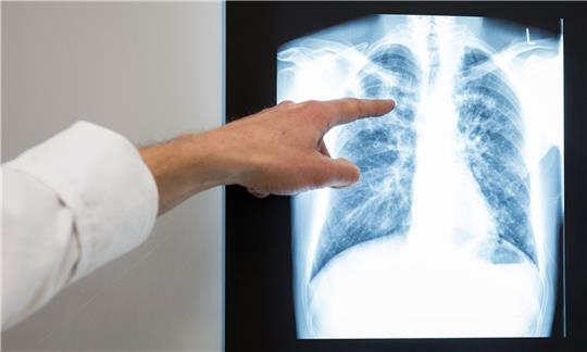 Röntgenbild einer Lunge. Im vergangenem Jahr würden rund 4480 neue Tuberkulose-Fälle in Deutschland registriert.