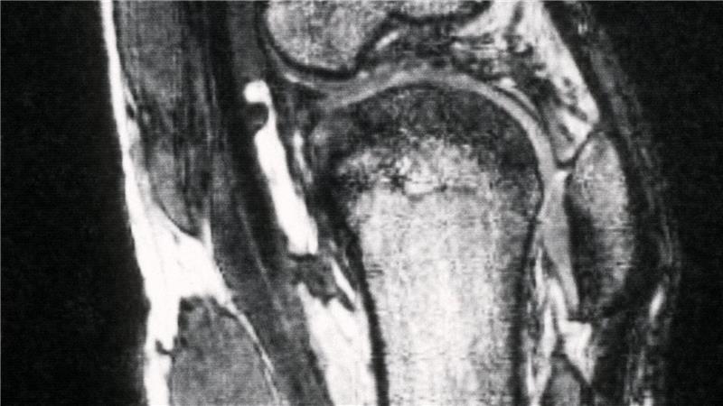 Kassen warnen vor riskanten Hüft- und Kniespritzen Schmerzen im Knie treiben viele Versicherte zum Orthopäden - viele kommen dort mit fragwürdigen Therapien in Kontakt. (Archivbild)