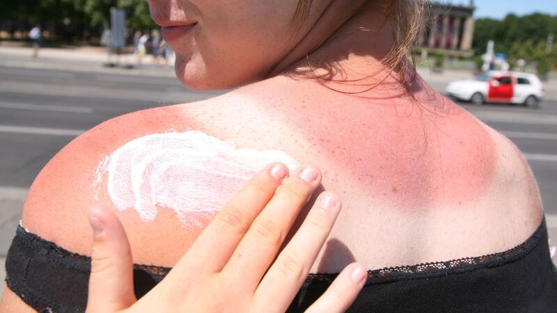 5 häufige Hautprobleme und was Sie dagegen tun können Sonnenbrand kann zu Hautproblemen wie Falten und Altersflecken führen.