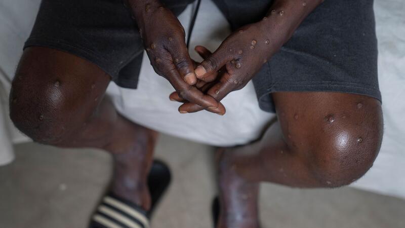 Höchste Alarmstufe wegen Mpox - was bedeutet das? Typisch für Mpox ist ein Hautausschlag, der schmerzhaft sein kann. (Archivbild)