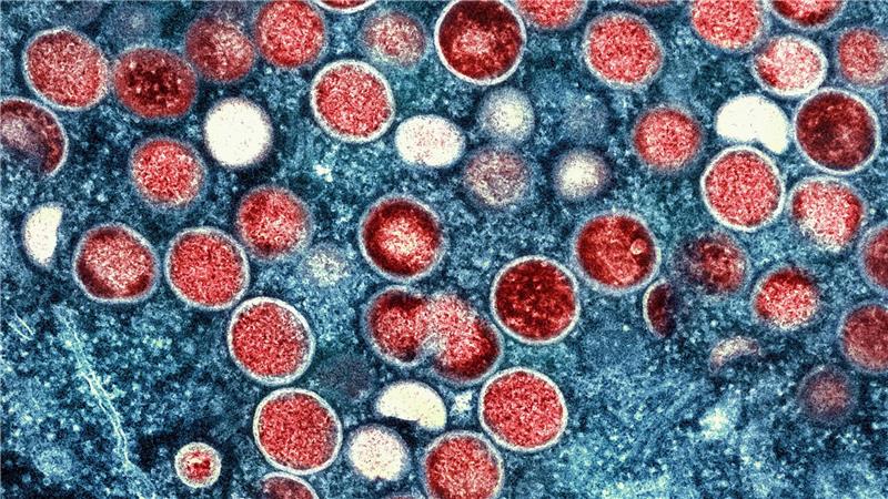 Experten-Warnung: Mpox könnte zu ernster Bedrohung werden Überlässt die Welt die Zukunft von Mpox der Natur und dem Zufall? (Archivbild)