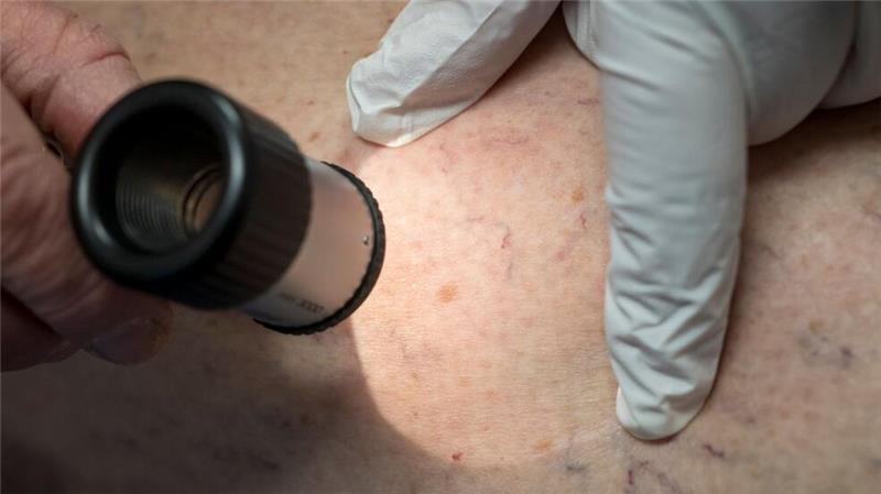 Frühlingswetter: UV-Schutz essenziell für Krebsprävention Wenn ein Muttermal seine Form oder Farbe ändert, sollte das von einem Arzt untersucht werden.